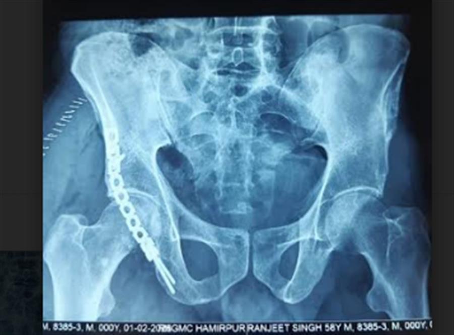 मेडिकल कालेज हमीरपुर की टीम ने की कूल्‍हे के फ्रेक्‍चर की जटिल सर्जरी
